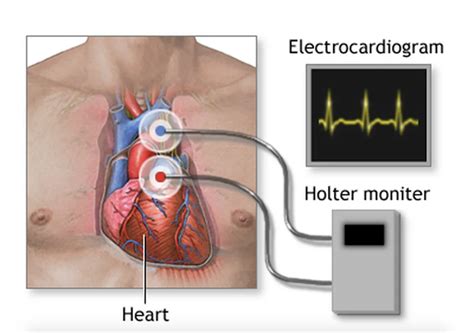 24 hour Holter Heart Monitor - Access Health Care Physicians