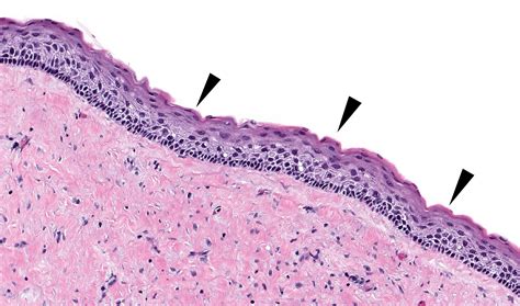 Odontogenic Keratocyst Histology