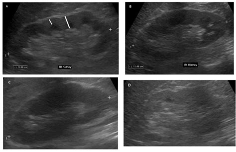 Normal Kidney Ultrasound