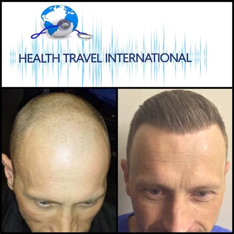 Hair Transplant Post Op Pics - Best Hairstyles Ideas for Women and Men ...