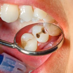Dental Caries Treatment in Ponnur | Tooth Decay Treatment in Ponnur