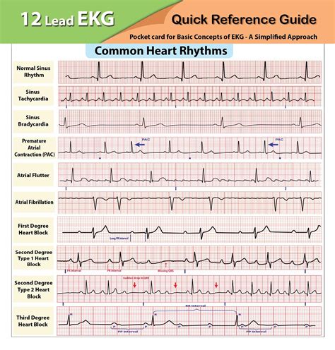 Amazon.com: EKG Pocket Card: 9781941004067: APRN World: Books ...