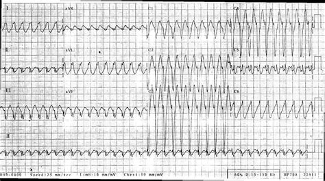 Image result for Wide Complex Tachycardia Algorithm
