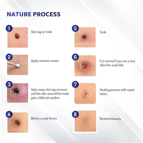 A Mole Turns Into Scab