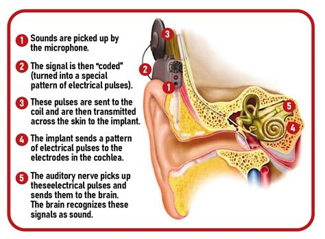 Is your child hearing right? Why cochlear implants for kids help them hear and speak normally ...
