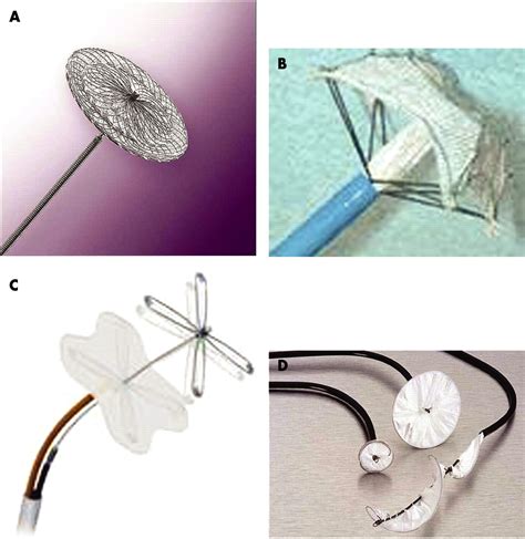 When to close a patent foramen ovale | Archives of Disease in Childhood