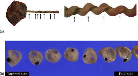 What Causes Umbilical Cord Thrombosis at Jaime Trujillo blog