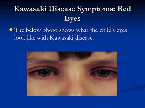 PPT - KAWASAKI DISEASE PowerPoint Presentation, free download - ID:224841