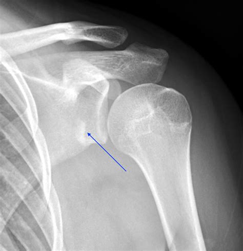 X Ray Shoulder Dislocation