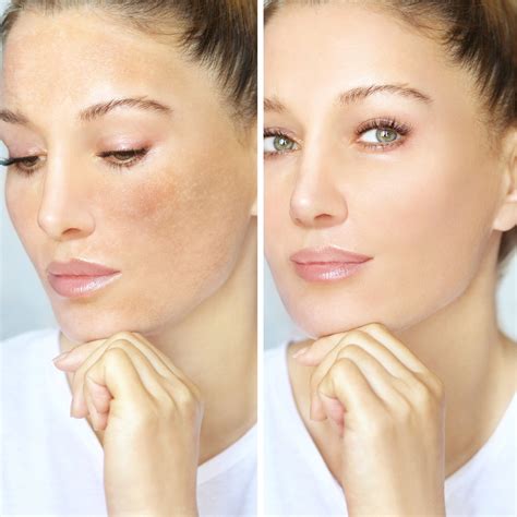 How to Treat Melasma