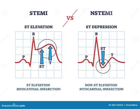 Electrocardiogram STEMI And NSTEMI Abnormal Heart Rate Outline Diagram ...