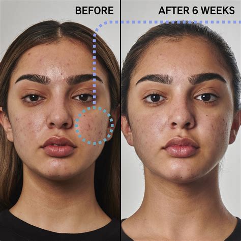 The INKEY List SuperSolutions 5% Benzoyl Peroxide Cleanser Acne ...