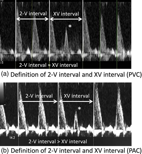 Premature Atrial Contractions Vs Premature Ventricular Contractions