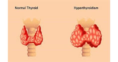 Image result for hyperthyroidism