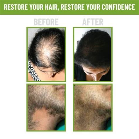 Alopecia Areata Medicine | Ayurvedic Treatment of Penu Korukudu
