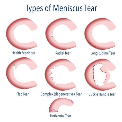 Torn Meniscus Injury Treatment | Knee Meniscus Repair Surgery