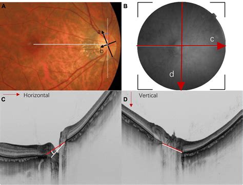 Frontiers | Myopic tilted disc: Mechanism, clinical significance, and public health implication