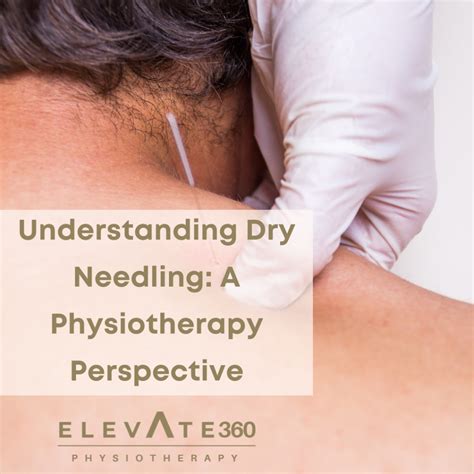 Understanding Dry Needling: A Physiotherapy Perspective - Elevate ...