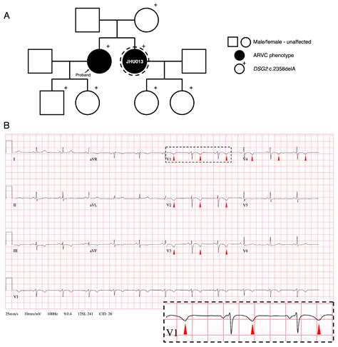 Altered Electrical, Biomolecular, and Immunologic Phenotypes in a Novel ...