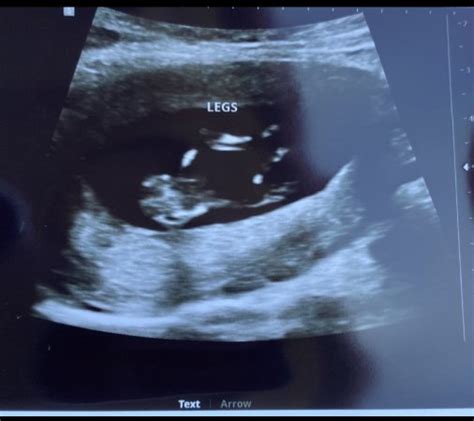 12 weeks 3 days nub theory ???? | BabyCenter