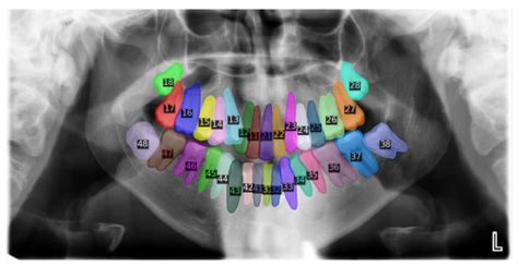 Teeth Segmentation in Panoramic Dental X-ray Using Mask Regional Convolutional Neural Network