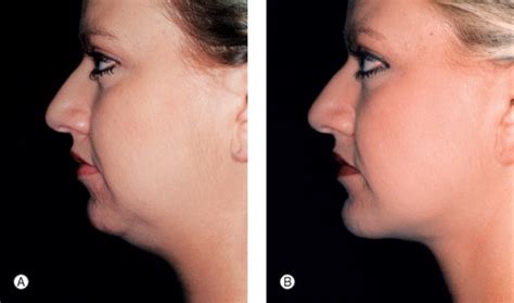 Dr. Goutam Guha - Facial Cosmetic Surgery : India, Kolkata, Scar ...