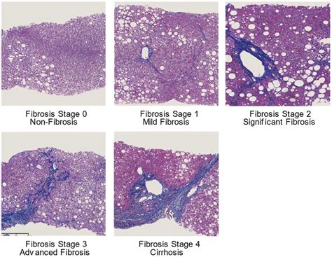 Elastography Techniques for the Assessment of Liver Fibrosis in Non ...