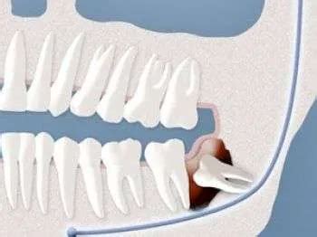 Wisdom Tooth Cyst Removal 的图像结果