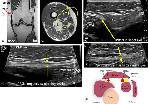 Saphenous Nerve Block