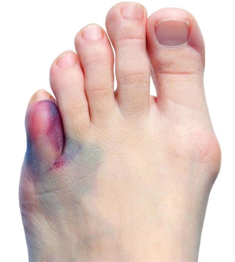 Bruise Under the Big Toenail Treatment: *Secrets Shared by a Podiatrist!*