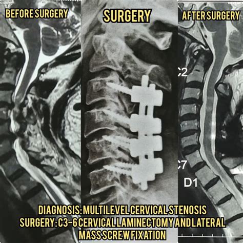 Posterior Cervical Spine Surgery - Dr. Nikhil Malewar