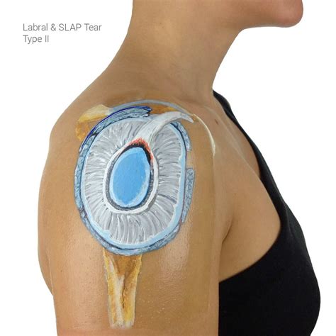 Shoulder Injuries | Durrant Orthopaedics