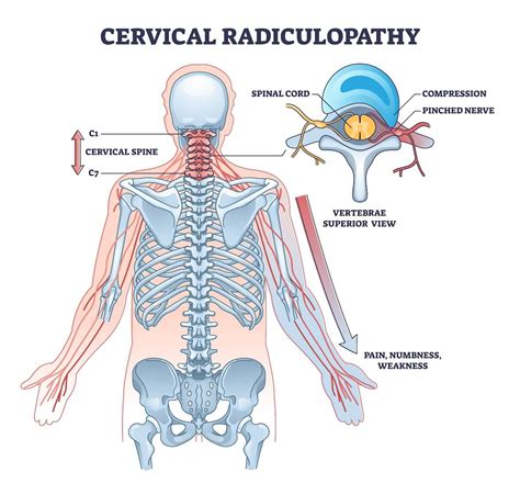 8 Exercises To Deal With Cervical Radiculopathy - Feel Good Life