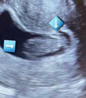 Ultrasound shows no arms/legs at 9 weeks. | BabyCenter
