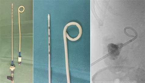Pigtail Catheter Chest Tube Placement at Lynn Morgan blog