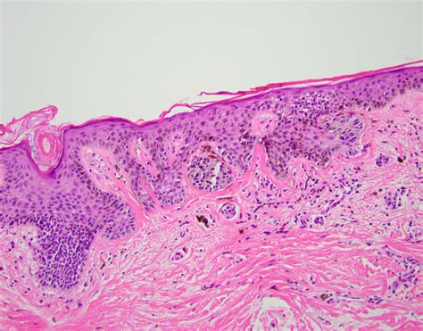 Dysplastic Nevus Histology Dysplastic Nevi Have An Overall Mutational