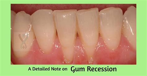 Tooth Recession 的图像结果