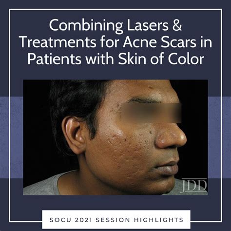 Combining Lasers & Treatments for Acne Scars in Patients with Skin of Color - Next Steps in ...