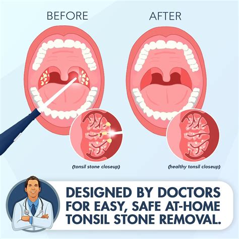 Dentist For Tonsil Stones