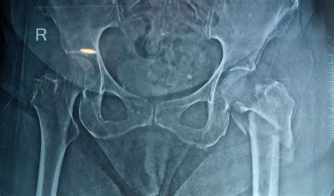 Hip Fractures Surgery in Ahmedabad | Dr. Rachit Sheth