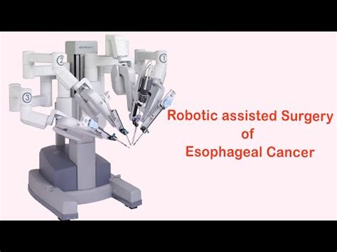 Esophageal Cancer Treatment in India: Cost, Top Hospitals