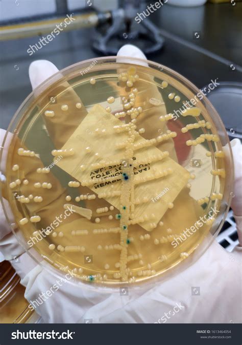 Image result for Staphylococcus Saprophyticus Infection