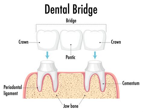 Dental Bridges - South San Francisco Dentist