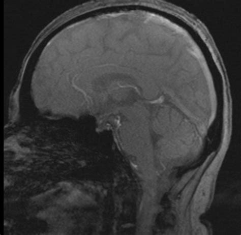 CSF Flow MRI 的图像结果