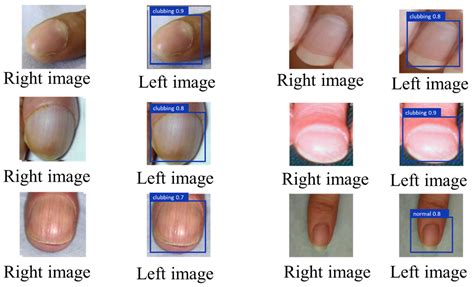 An Automated Clubbed Fingers Detection System Based on YOLOv8 and U-Net ...
