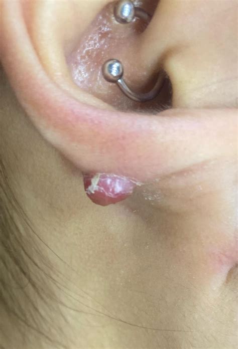 Is this a keloid??? : r/piercing