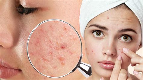 Pimples on Face: యుక్త వయస్సు దాటాక కూడా మొటిమలు వస్తున్నాయా ...
