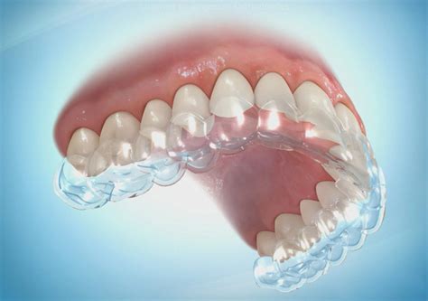 Types Of Clear Retainers