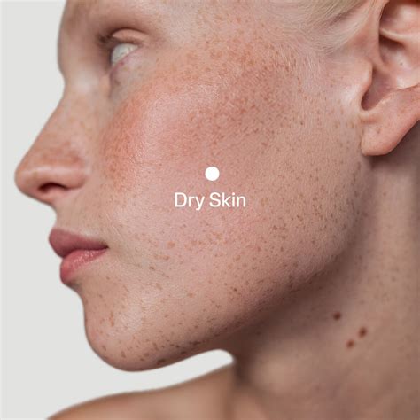 What Causes Dry Skin in Winter & How to Fix It