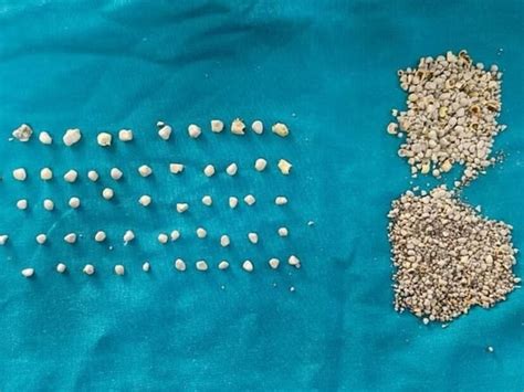 Kidney Stones Vs Gall Bladder Stones: కిడ్నీలో రాళ్లు Vs పిత్తాశయ ...